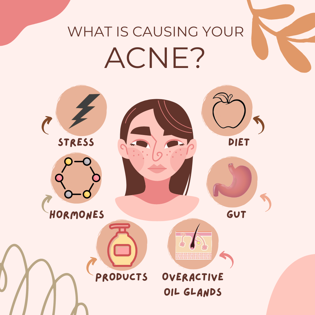 what is causing your acne?